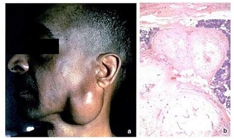 Malignant transformation of presumed pleomorphic adenoma of lacrimal gland after 60 years. ADENOMA PLEOMÓRFO DE PARÓTIDA - Binipatia e higienismo