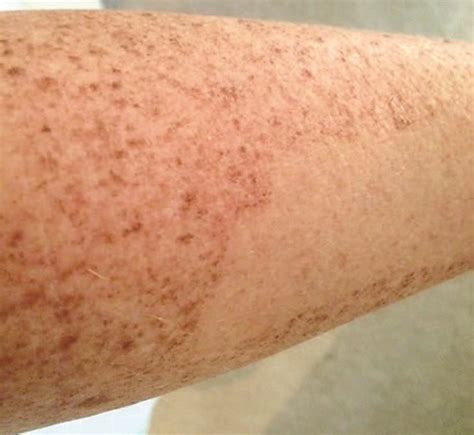 Age Spots On Arms