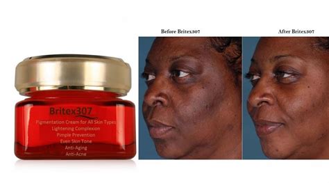 Skin pigmentation is nothing less than a nightmare for women. Hyperpigmentation - britex307 Cream