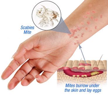 Clorox.com has been visited by 10k+ users in the past month 10 Ways to Get Rid of Scabies Fast and Naturally | HowHunter