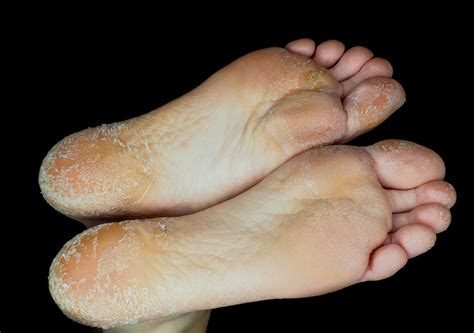 Skin Conditions That Make Your Feet Itch
