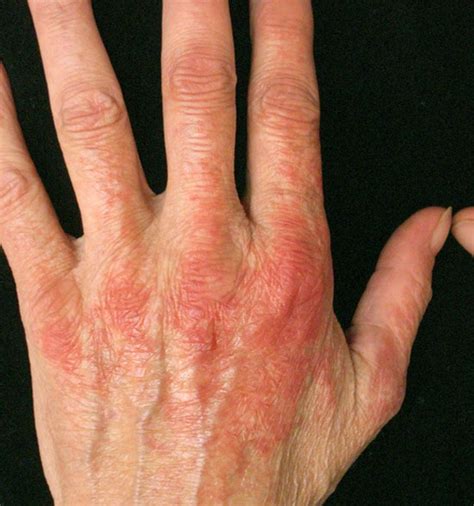 👉 Photodermatitis Pictures Treatment Symptoms And Causes November