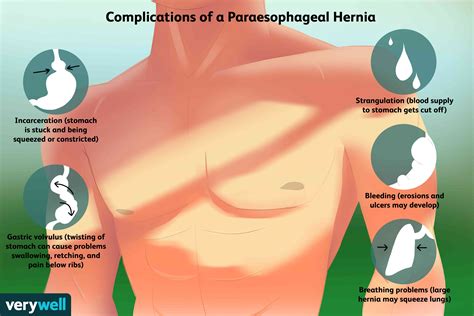 Paraesophageal Hiatal Hernia Symptoms And Treatments
