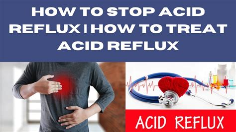 How To Stop Acid Reflux | How To Treat Acid Reflux 