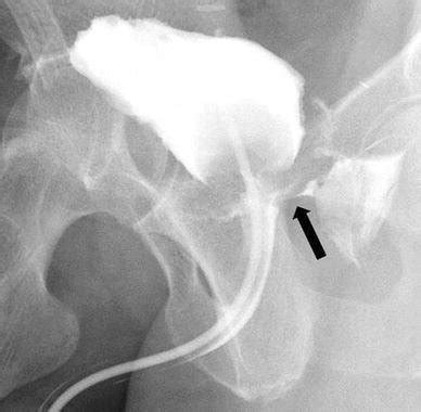 A Year Old Man With Intraoperative Rectal Injury Sustained During Download Scientific