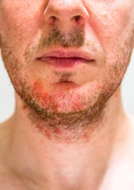 Seborrheic Dermatitis Stock Photos Pictures And Royalty Free Images Istock