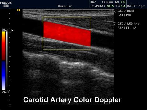 Ultrasound Images Common Carotid Artery Color Doppler Echogramm 328