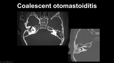 Otomastoiditis Summary Middle Ear Mri Mri Online Youtube