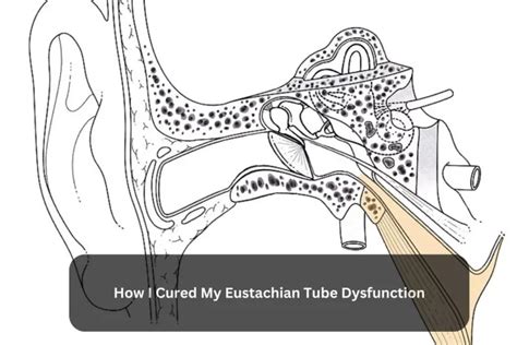 How I Cured My Eustachian Tube Dysfunction Teach Mood