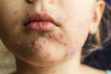 Facial Rash Caused By Yeast Infection Nude Gallery Comments