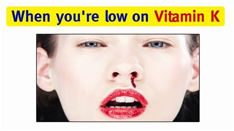 Vitamin K Top 10 Signs And Symptoms Of Vitamin K Deficiency Youtube