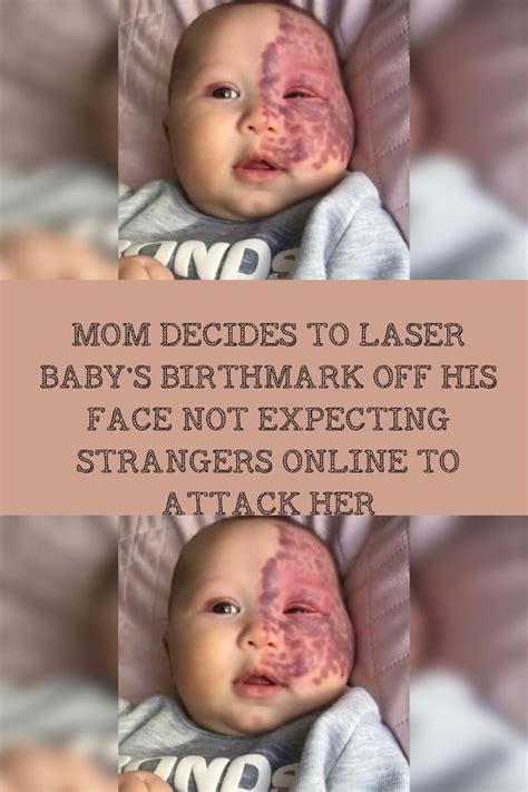 Mom Decides To Laser Babys Birthmark Off His Face Not Expecting