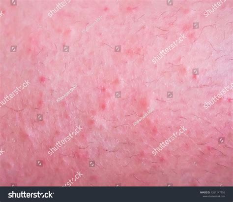 Skin Itching Rashred Spots On Skinred 스톡 사진 1351147355 Shutterstock