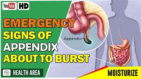 6 Emergency Signs Of An Appendix About To Burst Youtube