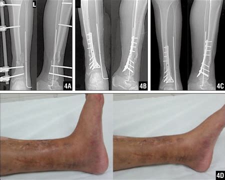 Home » bones » tibia and fibula » cast treatment of tibial fractures. Posteromedial Anatomical Plate for the Treatment of Distal ...