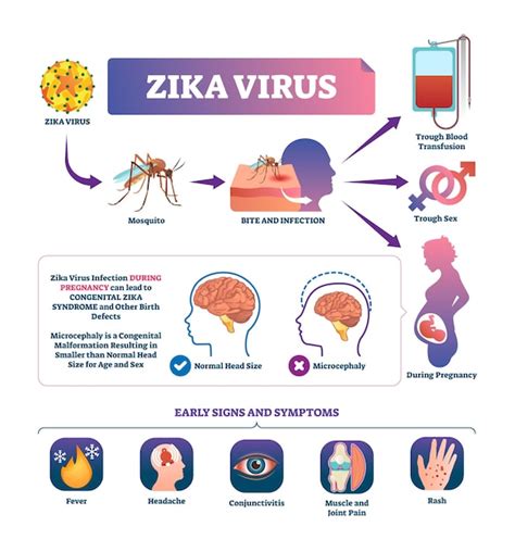 Ilustración de vector de virus zika esquema de signos y síntomas de infección por picadura de