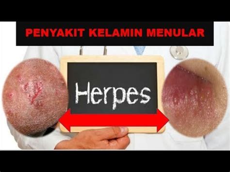 Ada masa laten tanpa manifestasi lesi di tubuh, dan dapat ditularkan. Obat Sipilis ( Raja Singa ) Alami, Sipilis Bisa Sembuh ...