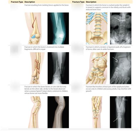 Bone Fracture Types Diagram Diagram Quizlet