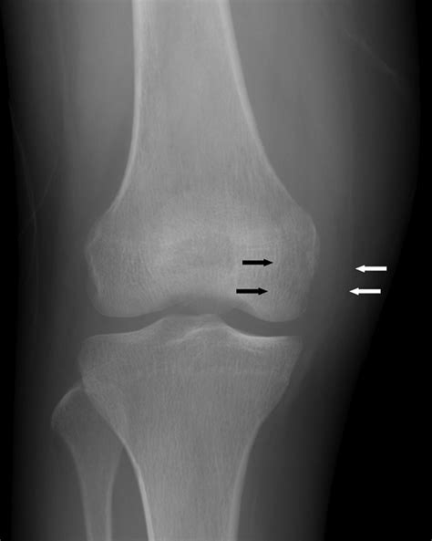Non Hodgkins Lymphoma Of The Knee A Case Report Iranian Journal Of