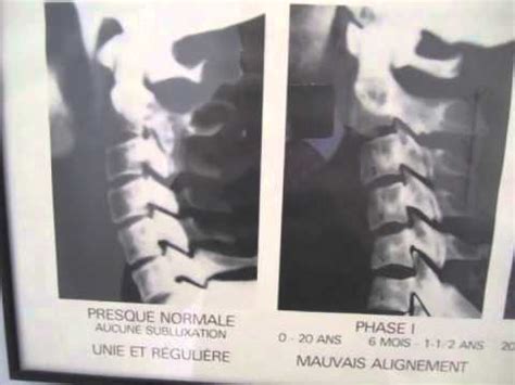 Síntomas y tratamiento (con que una una parte de solfa syllable comitiva se rectifique supone una lugar patológica que debemos. Lordosis Cervical Quiropractico - YouTube
