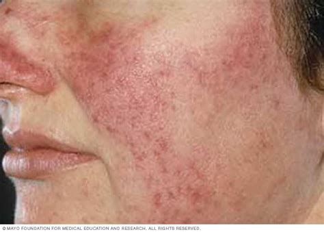 Rosacea Symptoms And Causes Mayo Clinic