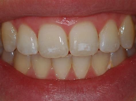 Have You Noticed These White Spots On Your Teeth Its One Of The First