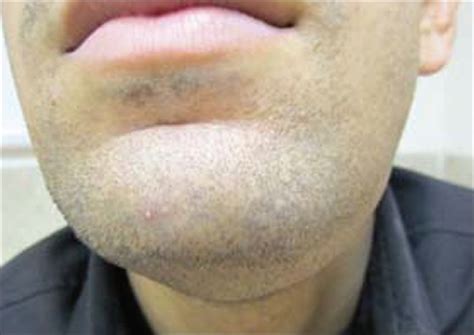 A Diffuse Soft Fluctuant Swelling Presents In The Left Submandibular