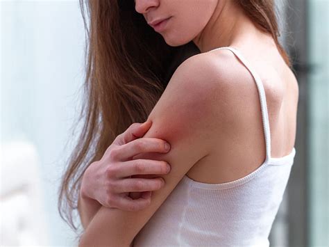 Dermatite Come Riconoscerla E Curarla Farmacia Notaro