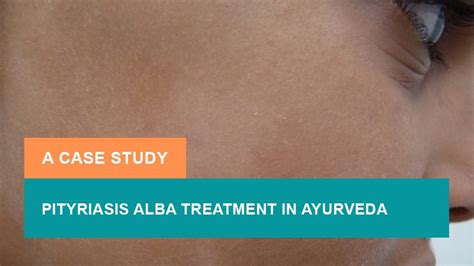 Pityriasis Alba Treatment In Ayurveda A Case Study