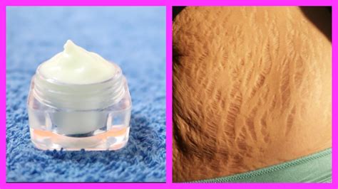 Maybe you would like to learn more about one of these? Home remedy for stretch marks || How to get rid of ...