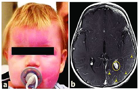 Clinical And Radiological Presentation Of Sturge Weber Syndrome Called
