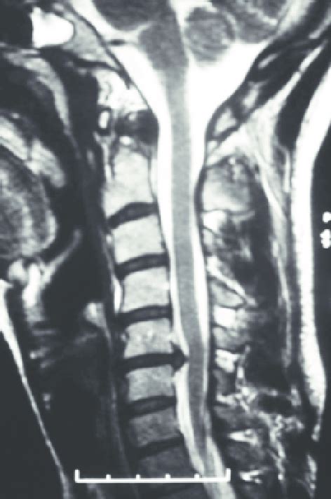 Case Example Diagnosis Of C5 C6 Disc Herniation In A Sagittal T2 Mri