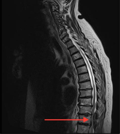 Acute Spinal Cord Compression A Rare Complication Of Dual Antiplatelet