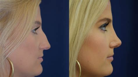Hump On Nose Bridge Rhinoplasty Before And After Photos Of Age 21 Female