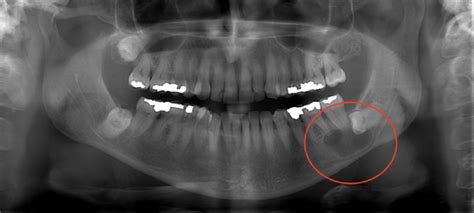Radicular Cyst Of Jaw A Case Report