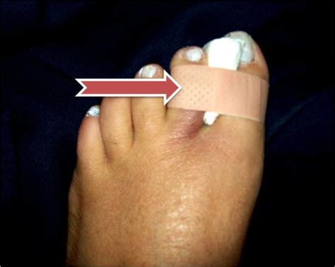 How To Treat An Injured Or Broken Toe By Buddy Taping Healthproadvice