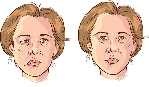Rarely, bell's palsy can recur. Acupuncture Treatment for Bell's Palsy - Aligned Modern Health