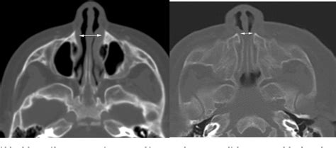 Figure 1 From Congenital Nasal Pyriform Aperture Stenosis In