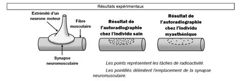 Comment faire la différence ? Sujet et corrigé "La myasthénie auto-immune" - Innover en svt