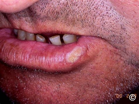 Leukoplakia