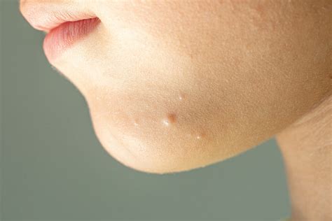 Molluscum Contagiosum Ny Hudson Dermatology