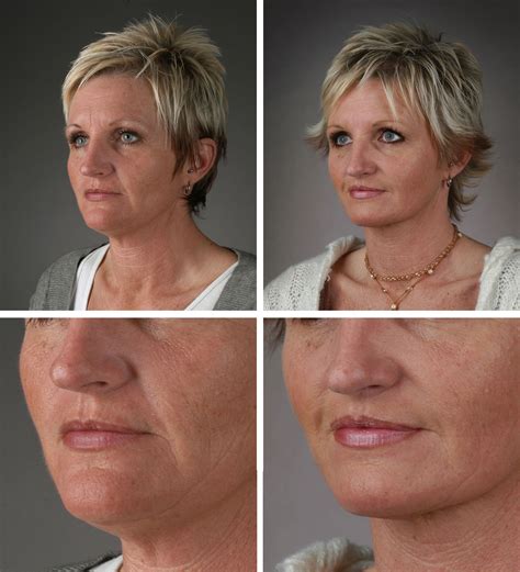 Before And After Photos Of Flexaway System Users Flexawaysystem Com Facial Exercises