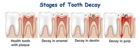 Dental Caries Cavities In Children Pediatric Dental Specialist