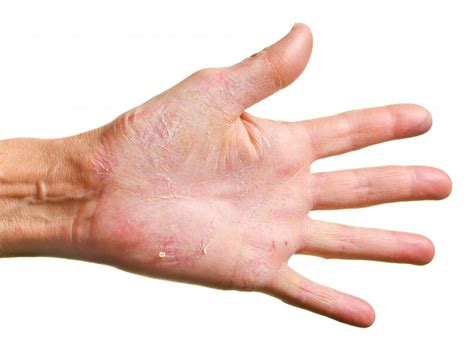 What Are The Causes Of Dermatitis With Pictures