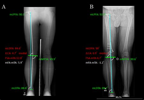 Realignment Osteotomy Knee Replacements In London