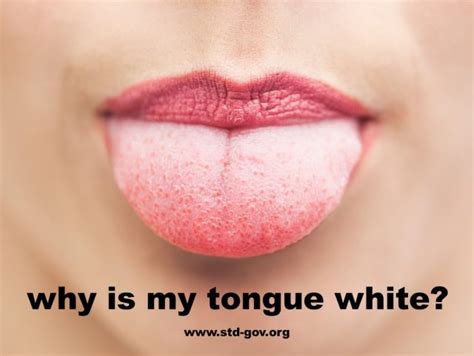 Why Is My Tongue White? | causes, symptoms, treatment, pictures