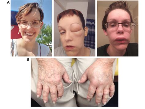 Representative Photographs Of Hereditary Angioedema Attacks Affecting A