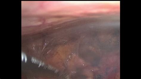 Endometriosis is measured in four stages of the disease and helps to give a medical guideline of how far the disease has developed. 12cm ENDOMETRIOMA--STAGE 4 PELVIC ENDOMETRIOSIS - YouTube