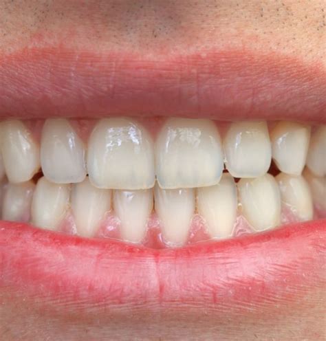 O Poder Da Ortodontia Confira A Transformação Que O Aparelho Ortodôntico Faz Pelos Seus Dentes