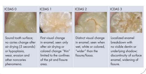 Icdas Scoring Criteria For Healthy Score Noncavitated Lesions